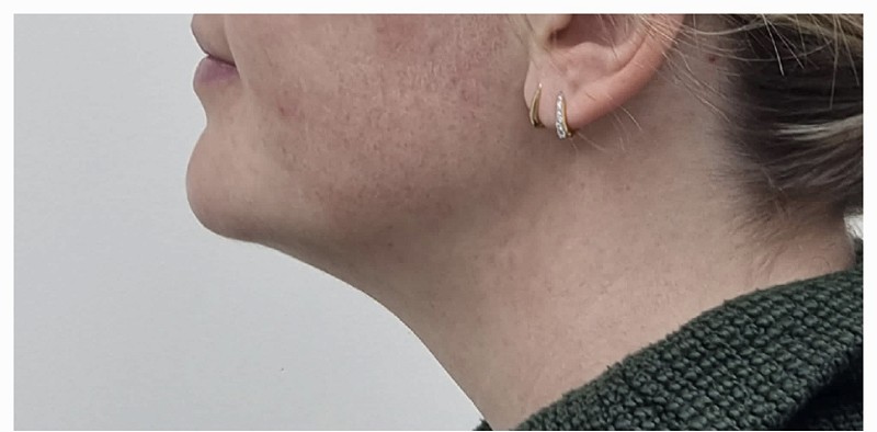 Dermal Filler for Jawline