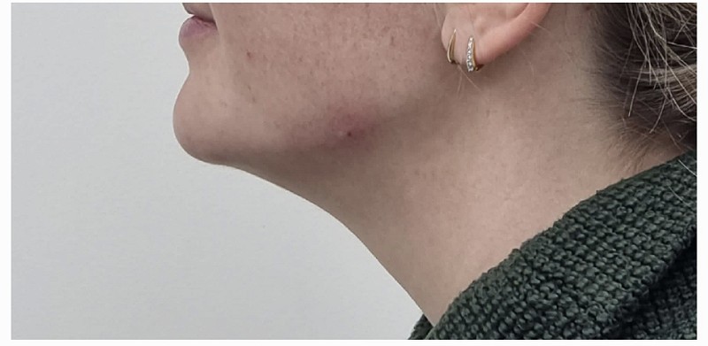 Dermal Filler for Jawline